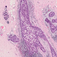 非浸潤性乳管癌